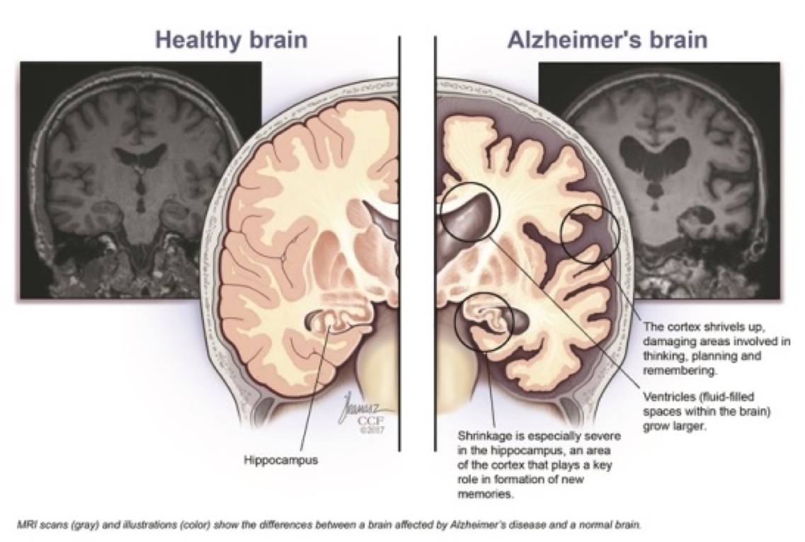 How Alzheimer’s Affects The Brain Sensations Memory Care Residence